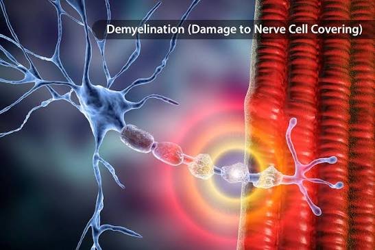 Multiple Sclerosis